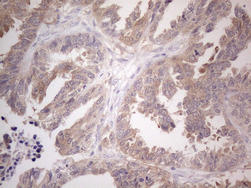 CAMK2B / CaMKII Beta Antibody - Immunohistochemical staining of paraffin-embedded Adenocarcinoma of Human ovary tissue using anti-CAMK2B mouse monoclonal antibody. (Heat-induced epitope retrieval by 1mM EDTA in 10mM Tris buffer. (pH8.5) at 120°C for 3 min. (1:150)