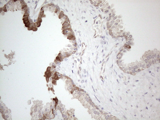 CAMK2B / CaMKII Beta Antibody - Immunohistochemical staining of paraffin-embedded Carcinoma of Human prostate tissue using anti-CAMK2B mouse monoclonal antibody. (Heat-induced epitope retrieval by 1mM EDTA in 10mM Tris buffer. (pH8.5) at 120°C for 3 min. (1:150)