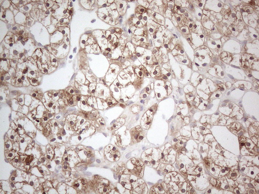 CAMK2B / CaMKII Beta Antibody - Immunohistochemical staining of paraffin-embedded Carcinoma of Human kidney tissue using anti-CAMK2B mouse monoclonal antibody. (Heat-induced epitope retrieval by 1mM EDTA in 10mM Tris buffer. (pH8.5) at 120°C for 3 min. (1:150)