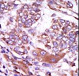 CAMK2D / CaMKII Delta Antibody - Formalin-fixed and paraffin-embedded human cancer tissue reacted with the primary antibody, which was peroxidase-conjugated to the secondary antibody, followed by AEC staining. This data demonstrates the use of this antibody for immunohistochemistry; clinical relevance has not been evaluated. BC = breast carcinoma; HC = hepatocarcinoma.
