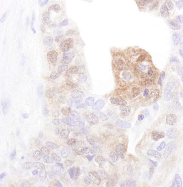 CAMK4 / CaMK IV Antibody - Detection of Human CanK4 by Immunohistochemistry. Sample: FFPE section of human ovarian carcinoma. Antibody: Affinity purified rabbit anti-CamK4 used at a dilution of 1:1000 (0.2 ug/ml).