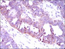 CAMK4 / CaMK IV Antibody - IHC of paraffin-embedded ovarian cancer tissues using CAMK4 mouse monoclonal antibody with DAB staining.