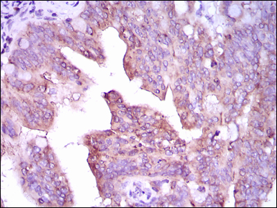 CAMK4 / CaMK IV Antibody - IHC of paraffin-embedded rectum cancer tissues using CAMK4 mouse monoclonal antibody with DAB staining.