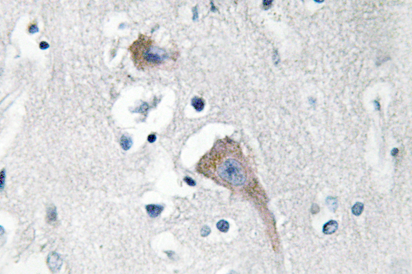 CaMKII Alpha+Delta Antibody - IHC of CaMKII/ (M281) pAb in paraffin-embedded human breast carcinoma tissue.
