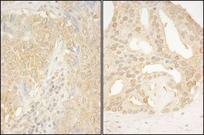 CAMKK1 Antibody - Detection of Human CaMKK alpha by Immunohistochemistry. Sample: FFPE section of human lung carcinoma (left) and human prostate carcinoma (right). Antibody: Affinity purified rabbit anti-CaMKK alpha used at a dilution of 1:200 (1 ug/ml). Detection: DAB.