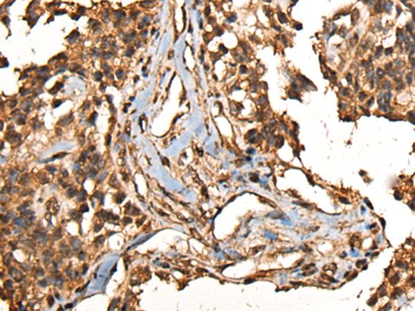 CAMKK1 Antibody - Immunohistochemistry of paraffin-embedded Human ovarian cancer tissue  using CAMKK1 Polyclonal Antibody at dilution of 1:35(×200)