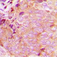 CAMKK2 Antibody - Immunohistochemical analysis of CaMKK beta staining in human breast cancer formalin fixed paraffin embedded tissue section. The section was pre-treated using heat mediated antigen retrieval with sodium citrate buffer (pH 6.0). The section was then incubated with the antibody at room temperature and detected with HRP and DAB as chromogen. The section was then counterstained with hematoxylin and mounted with DPX.