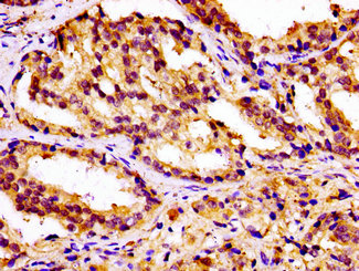 CAMKK2 Antibody - Immunohistochemistry image at a dilution of 1:100 and staining in paraffin-embedded human prostate cancer performed on a Leica BondTM system. After dewaxing and hydration, antigen retrieval was mediated by high pressure in a citrate buffer (pH 6.0) . Section was blocked with 10% normal goat serum 30min at RT. Then primary antibody (1% BSA) was incubated at 4 °C overnight. The primary is detected by a biotinylated secondary antibody and visualized using an HRP conjugated SP system.