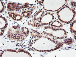 CAMLG / CAML Antibody - IHC of paraffin-embedded Carcinoma of Human thyroid tissue using anti-CAMLG mouse monoclonal antibody. (Heat-induced epitope retrieval by 10mM citric buffer, pH6.0, 100C for 10min).