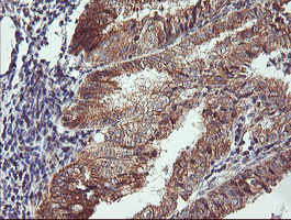 CAMLG / CAML Antibody - IHC of paraffin-embedded Adenocarcinoma of Human endometrium tissue using anti-CAMLG mouse monoclonal antibody. (Heat-induced epitope retrieval by 10mM citric buffer, pH6.0, 100C for 10min).