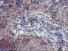 CAMLG / CAML Antibody - IHC of paraffin-embedded Carcinoma of Human bladder tissue using anti-CAMLG mouse monoclonal antibody. (Heat-induced epitope retrieval by 10mM citric buffer, pH6.0, 100C for 10min).