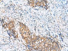 CAMSAP3 / KIAA1543 Antibody - Immunohistochemistry of paraffin-embedded Human cervical cancer tissue  using CAMSAP3 Polyclonal Antibody at dilution of 1:110(×200)