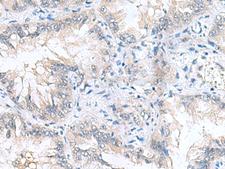 CAMSAP3 / KIAA1543 Antibody - Immunohistochemistry of paraffin-embedded Human lung cancer tissue  using CAMSAP3 Polyclonal Antibody at dilution of 1:90(×200)