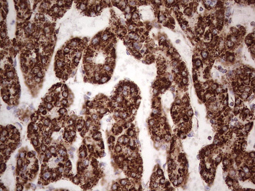 CANT1 Antibody - IHC of paraffin-embedded Carcinoma of Human liver tissue using anti-CANT1 mouse monoclonal antibody. (Heat-induced epitope retrieval by 1 mM EDTA in 10mM Tris, pH8.5, 120°C for 3min).