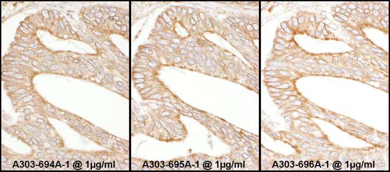 CANX / Calnexin Antibody - Detection of Human Calnexin by Immunohistochemistry. Samples: FFPE sections of human breast carcinoma. Antibody: Affinity purified rabbit anti-Calnexin used at a dilution of 1:1000 (center). Detection: DAB.