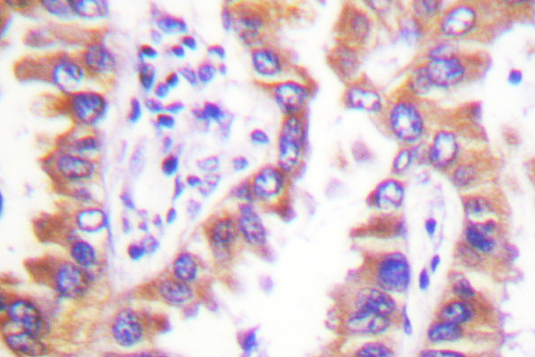 CANX / Calnexin Antibody - IHC of Calnexin (D577) pAb in paraffin-embedded human lung carcinoma tissue.