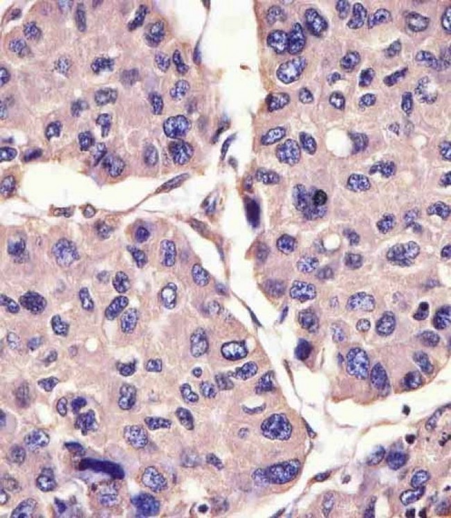 CANX / Calnexin Antibody - CANX Antibody (C-Term) staining CANX in human hepatocarcinoma sections by Immunohistochemistry (IHC-P - paraformaldehyde-fixed, paraffin-embedded sections). Tissue was fixed with formaldehyde and blocked with 3% BSA for 0. 5 hour at room temperature; antigen retrieval was by heat mediation with a citrate buffer (pH6). Samples were incubated with primary antibody (1/25) for 1 hours at 37°C. A undiluted biotinylated goat polyvalent antibody was used as the secondary antibody.