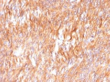 CANX / Calnexin Antibody - IHC testing of FFPE human small intestine carcinoma with Calnexin antibody. HIER: boil tissue sections in 10mM Tris with 1mM EDTA, pH 9.0 for 10-20 min.