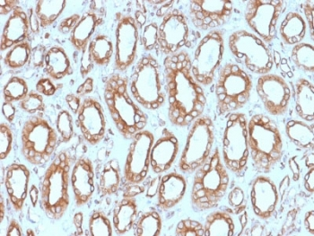 CANX / Calnexin Antibody - IHC testing of FFPE human renal cell carcinoma with Calnexin antibody (clone CANX/1543). HIER: boil tissue sections in pH6, 10mM citrate buffer, for 10-20 min followed by cooling at RT for 20 min.