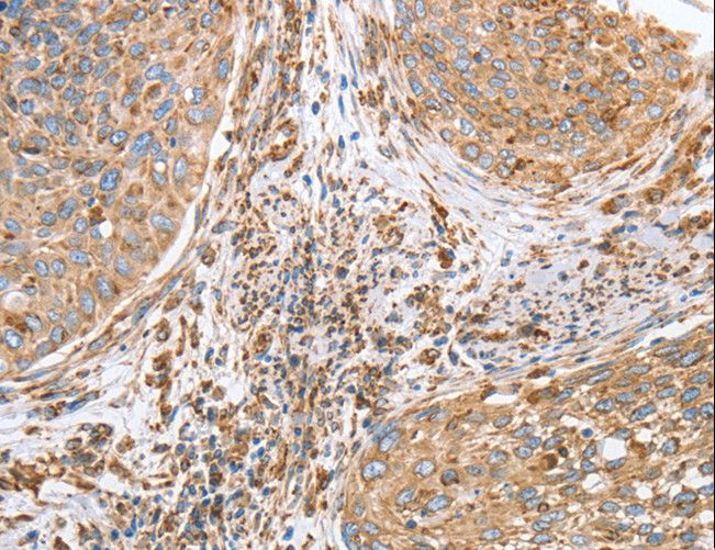 CANX / Calnexin Antibody - Immunohistochemistry of paraffin-embedded Human cervical cancer using CANX Polyclonal Antibody at dilution of 1:40.