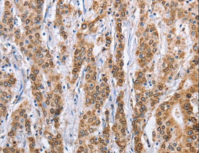 CANX / Calnexin Antibody - Immunohistochemistry of paraffin-embedded Human gastric cancer using CANX Polyclonal Antibody at dilution of 1:40.