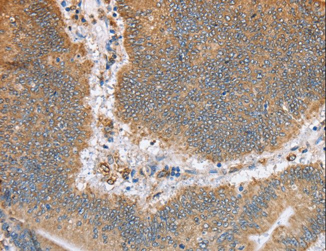 CANX / Calnexin Antibody - Immunohistochemistry of paraffin-embedded Human colon cancer using CANX Polyclonal Antibody at dilution of 1:50.