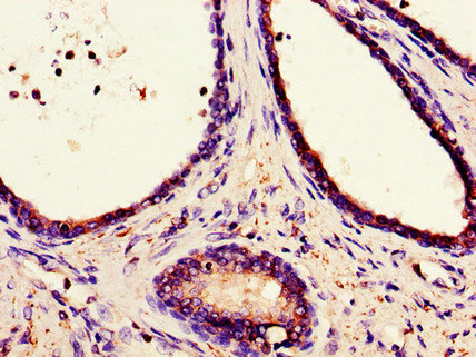 CANX / Calnexin Antibody - Immunohistochemistry of paraffin-embedded human prostate cancer using CANX Antibody at dilution of 1:100
