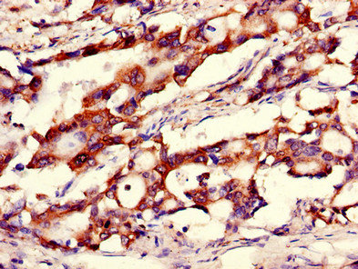 CANX / Calnexin Antibody - Immunohistochemistry of paraffin-embedded human gastric cancer using CANX Antibody at dilution of 1:100