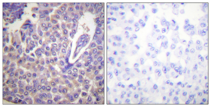 CANX / Calnexin Antibody - Immunohistochemistry analysis of paraffin-embedded human breast carcinoma, using Calnexin (Phospho-Ser583) Antibody. The picture on the right is blocked with the phospho peptide.
