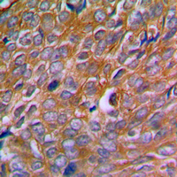 CANX / Calnexin Antibody - Immunohistochemical analysis of Calnexin (pS583) staining in human breast cancer formalin fixed paraffin embedded tissue section. The section was pre-treated using heat mediated antigen retrieval with sodium citrate buffer (pH 6.0). The section was then incubated with the antibody at room temperature and detected using an HRP conjugated compact polymer system. DAB was used as the chromogen. The section was then counterstained with hematoxylin and mounted with DPX.