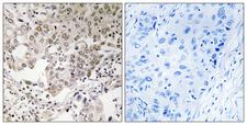 CAP-G2 / MTB Antibody - Immunohistochemistry analysis of paraffin-embedded human lung carcinoma, using NCAPG2 Antibody. The picture on the right is blocked with the synthesized peptide.