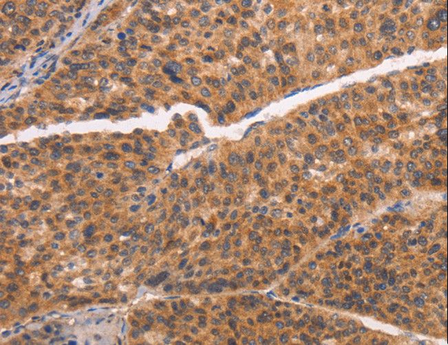 CAP-G2 / MTB Antibody - Immunohistochemistry of paraffin-embedded Human liver cancer using NCAPG2 Polyclonal Antibody at dilution of 1:50.