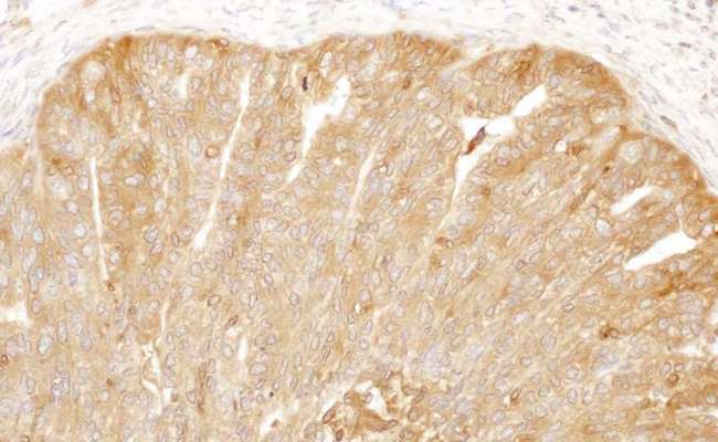 CAP1 Antibody - Detection of human CAP1 by immunohistochemistry. Sample: FFPE section of human ovarian carcinoma. Antibody: Affinity purified rabbit anti- CAP1 used at a dilution of 1:1,000 (1µg/ml). Detection: DAB