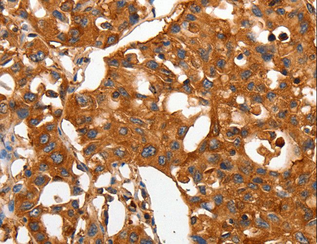 CAP2 Antibody - Immunohistochemistry of paraffin-embedded Human lung cancer using CAP2 Polyclonal Antibody at dilution of 1:50.