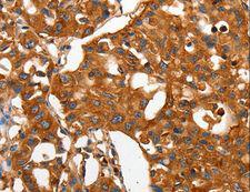 CAP2 Antibody - Immunohistochemistry of paraffin-embedded Human lung cancer using CAP2 Polyclonal Antibody at dilution of 1:50.