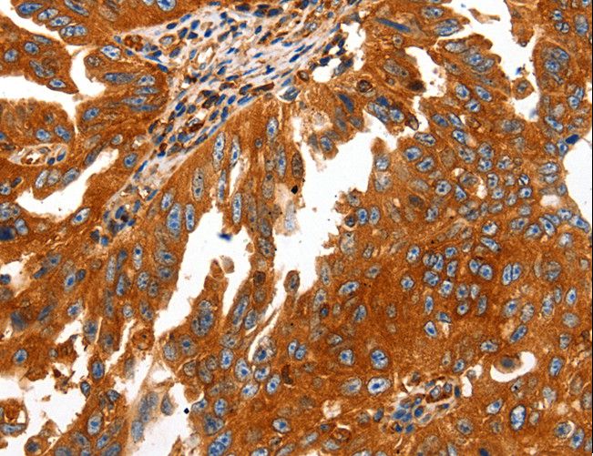 CAP2 Antibody - Immunohistochemistry of paraffin-embedded Human ovarian cancer using CAP2 Polyclonal Antibody at dilution of 1:50.