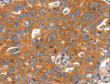 CAP2 Antibody - Immunohistochemistry of paraffin-embedded Human ovarian cancer using CAP2 Polyclonal Antibody at dilution of 1:60.