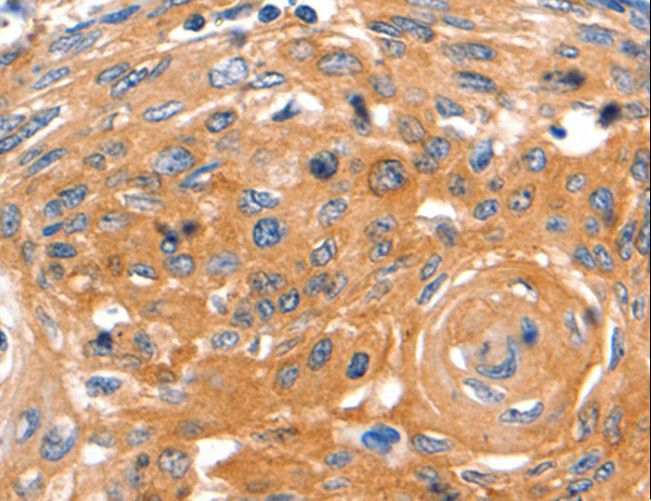 CAP2 Antibody - Immunohistochemistry of paraffin-embedded Human cervical cancer using CAP2 Polyclonal Antibody at dilution of 1:60.