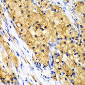 CAPG Antibody - Immunohistochemistry of paraffin-embedded human lung cancer tissue.