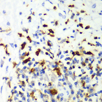 CAPG Antibody - Immunohistochemistry of paraffin-embedded human liver cancer tissue.