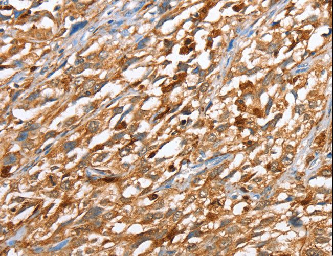 CAPG Antibody - Immunohistochemistry of paraffin-embedded Human esophagus cancer using CAPG Polyclonal Antibody at dilution of 1:40.