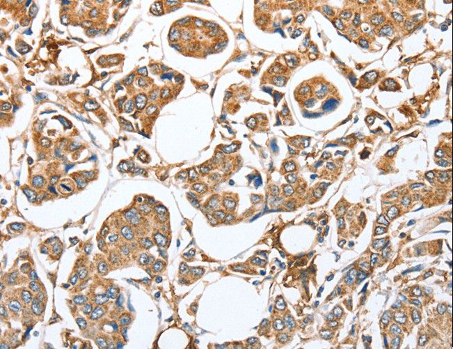 CAPG Antibody - Immunohistochemistry of paraffin-embedded Human breast cancer using CAPG Polyclonal Antibody at dilution of 1:35.