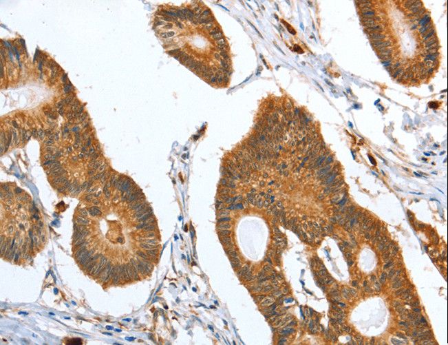 CAPG Antibody - Immunohistochemistry of paraffin-embedded Human colon cancer using CAPG Polyclonal Antibody at dilution of 1:35.