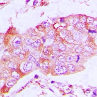 CAPG Antibody - Immunohistochemical analysis of CapG staining in human lung cancer formalin fixed paraffin embedded tissue section. The section was pre-treated using heat mediated antigen retrieval with sodium citrate buffer (pH 6.0). The section was then incubated with the antibody at room temperature and detected using an HRP conjugated compact polymer system. DAB was used as the chromogen. The section was then counterstained with hematoxylin and mounted with DPX.
