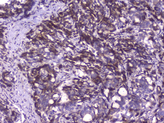 Capicua / CIC Antibody - IHC analysis of CIC using anti-CIC antibody. CIC was detected in paraffin-embedded section of human gastric cancer tissue. Heat mediated antigen retrieval was performed in citrate buffer (pH6, epitope retrieval solution) for 20 mins. The tissue section was blocked with 10% goat serum. The tissue section was then incubated with 1µg/ml rabbit anti-CIC Antibody overnight at 4°C. Biotinylated goat anti-rabbit IgG was used as secondary antibody and incubated for 30 minutes at 37°C. The tissue section was developed using Strepavidin-Biotin-Complex (SABC) with DAB as the chromogen.