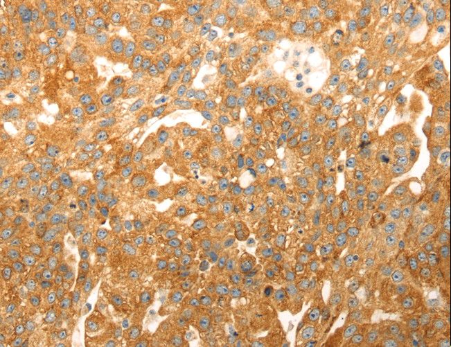 CAPN1 / Calpain 1 Antibody - Immunohistochemistry of paraffin-embedded Human breast cancer using CAPN1 Polyclonal Antibody at dilution of 1:20.