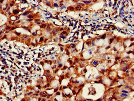 CAPN1 / Calpain 1 Antibody - Immunohistochemistry of paraffin-embedded human lung cancer at dilution of 1:100