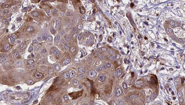 CAPN1 / Calpain 1 Antibody - 1:100 staining human liver carcinoma tissues by IHC-P. The sample was formaldehyde fixed and a heat mediated antigen retrieval step in citrate buffer was performed. The sample was then blocked and incubated with the antibody for 1.5 hours at 22°C. An HRP conjugated goat anti-rabbit antibody was used as the secondary.