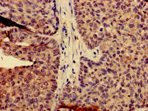 CAPN14 Antibody - Immunohistochemistry of paraffin-embedded human ovarian cancer at dilution of 1:100