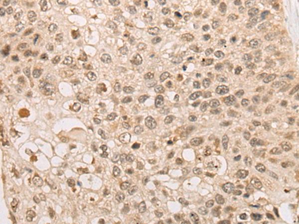 CAPN15 / SOLH Antibody - Immunohistochemistry of paraffin-embedded Human lung cancer tissue  using CAPN15 Polyclonal Antibody at dilution of 1:50(×200)